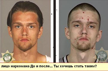 лицо наркомана до и после